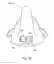 Fig. 20 - Vent system for CPAP patient interface used in treatment of sleep disordered breathing