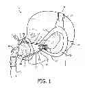 Fig. 02 - Patient interface assembly with self-adjusting anchor points