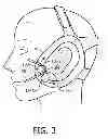Fig. 04 - Patient interface assembly with self-adjusting anchor points