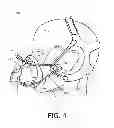 Fig. 05 - Patient interface assembly with self-adjusting anchor points
