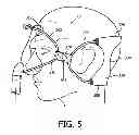 Fig. 06 - Patient interface assembly with self-adjusting anchor points