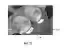 Fig. 20 - Rolling cutter with bottom support
