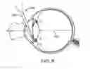 Fig. 09 - Fasteners, deployment systems, and methods for ophthalmic tissue closure and fixation of ophthalmic prostheses and other uses