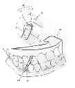 Fig. 01 - CLEAR ALIGNER AND MANUFACTURING METHOD THEREOF, TRACTION DEVICE FOR CLEAR ALIGNER, AND AID FOR TRACTION DEVICE FOR CLEAR ALIGNER