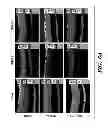 Fig. 05 - USE OF CHELATORS OF DIVALENT CATIONS TO PROMOTE NERVE REGENERATION