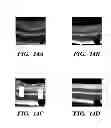 Fig. 22 - USE OF CHELATORS OF DIVALENT CATIONS TO PROMOTE NERVE REGENERATION