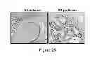 Fig. 03 - MARKERS FOR DCIS RECURRENCE: COORDINATE PTEN/RB LOSS