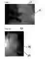 Fig. 06 - MICROFLUIDIC DEVICE FOR NUCLEIC ACID EXTRACTION AND FRACTIONATION