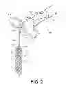 Fig. 05 - Kit for Placing Fixation Devices