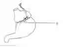 Fig. 01 - Gastric Constriction Device