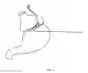 Fig. 02 - Gastric Constriction Device
