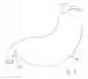Fig. 06 - Gastric Constriction Device