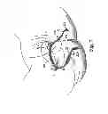 Fig. 09 - Methods and systems for treatment of prolapse