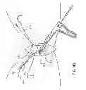 Fig. 17 - Kit for Placing Fixation Devices