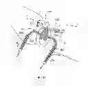 Fig. 34 - Kit for Placing Fixation Devices