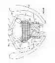 Fig. 44 - Kit for Placing Fixation Devices