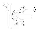 Fig. 63 - Kit for Placing Fixation Devices