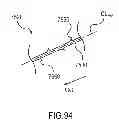 Fig. 90 - Kit for Placing Fixation Devices