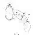 Fig. 96 - Kit for Placing Fixation Devices