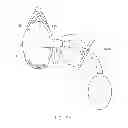 Fig. 10 - Apparatus For Treating Vaginal Prolapse