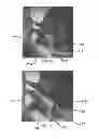 Fig. 12 - Apparatus For Treating Vaginal Prolapse