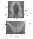 Fig. 13 - Apparatus For Treating Vaginal Prolapse