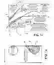 Fig. 14 - Apparatus For Treating Vaginal Prolapse