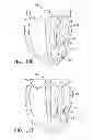 Fig. 16 - Systems and methods for improving cardiac function