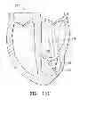 Fig. 22 - Systems and methods for improving cardiac function