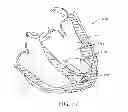 Fig. 44 - Systems and methods for improving cardiac function