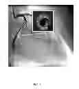 Fig. 07 - Locating intravascular images