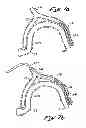Fig. 08 - Tissue Penetrating Catheters Having Integral Imaging Transducers and Their Methods of Use