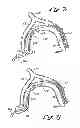 Fig. 12 - Tissue Penetrating Catheters Having Integral Imaging Transducers and Their Methods of Use
