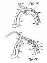 Fig. 13 - Tissue Penetrating Catheters Having Integral Imaging Transducers and Their Methods of Use