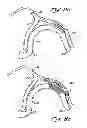 Fig. 14 - Tissue Penetrating Catheters Having Integral Imaging Transducers and Their Methods of Use