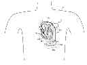 Fig. 01 - IMPLANTABLE MYOCARDIAL ISCHEMIA DETECTION, INDICATION AND ACTION TECHNOLOGY