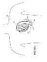 Fig. 04 - IMPLANTABLE MYOCARDIAL ISCHEMIA DETECTION, INDICATION AND ACTION TECHNOLOGY