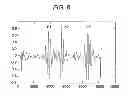 Fig. 09 - System and method for acoustic detection of coronary artery disease and automated editing of heart sound data