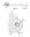 Fig. 02 - Tissue specimen isolating and damaging device and method