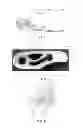 Fig. 05 - Use of additive manufacturing processes in the manufacture of custom orthoses