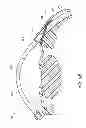 Fig. 13 - Intraocular shunt placement