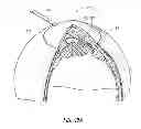 Fig. 14 - Intraocular shunt placement