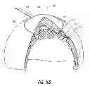 Fig. 15 - Intraocular shunt placement