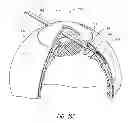 Fig. 16 - Intraocular shunt placement