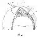 Fig. 17 - Intraocular shunt placement