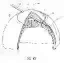Fig. 18 - Intraocular shunt placement