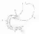 Fig. 01 - Device for anchoring an endoluminal sleeve in the GI tract