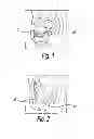 Fig. 02 - Tampon assembly providing proper bodily placement of pledget