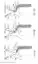 Fig. 16 - Variable length catheter for drug delivery