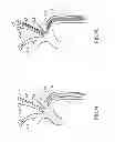 Fig. 14 - Variable length catheter for drug delivery